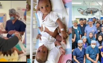 Are Nigerians not capable? Saudi Surgeons separate Nigerian conjoined twins:ikejabird.com