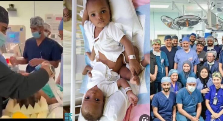 Are Nigerians not capable? Saudi Surgeons separate Nigerian conjoined twins:ikejabird.com