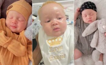 Mum shares story of how her cute baby was diagnosed with albinism
