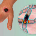 Anthrax! – What you need to know about the deadly disease