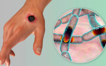 Anthrax! – What you need to know about the deadly disease