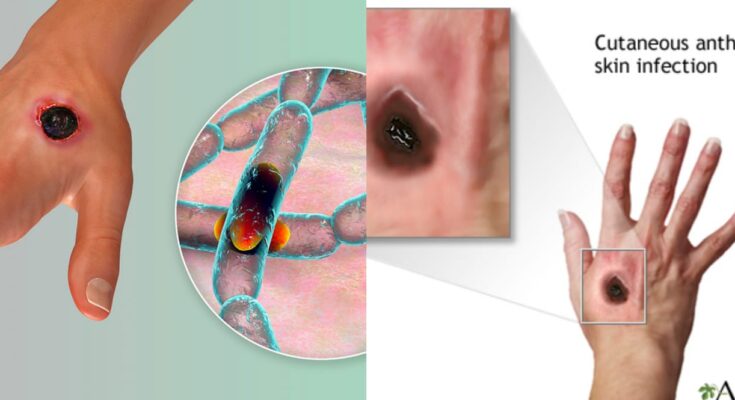 Nigeria at high risk of anthrax outbreak, FG warns | Ikejabird.com